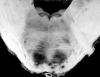 Pontine hemorrhages in a patient with thrombotic thrombocytopenic purpura